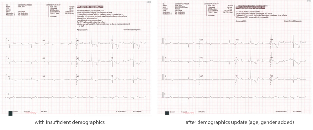 BeneHeart R12 Electrocardiograph India