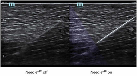 Safe Needling Features